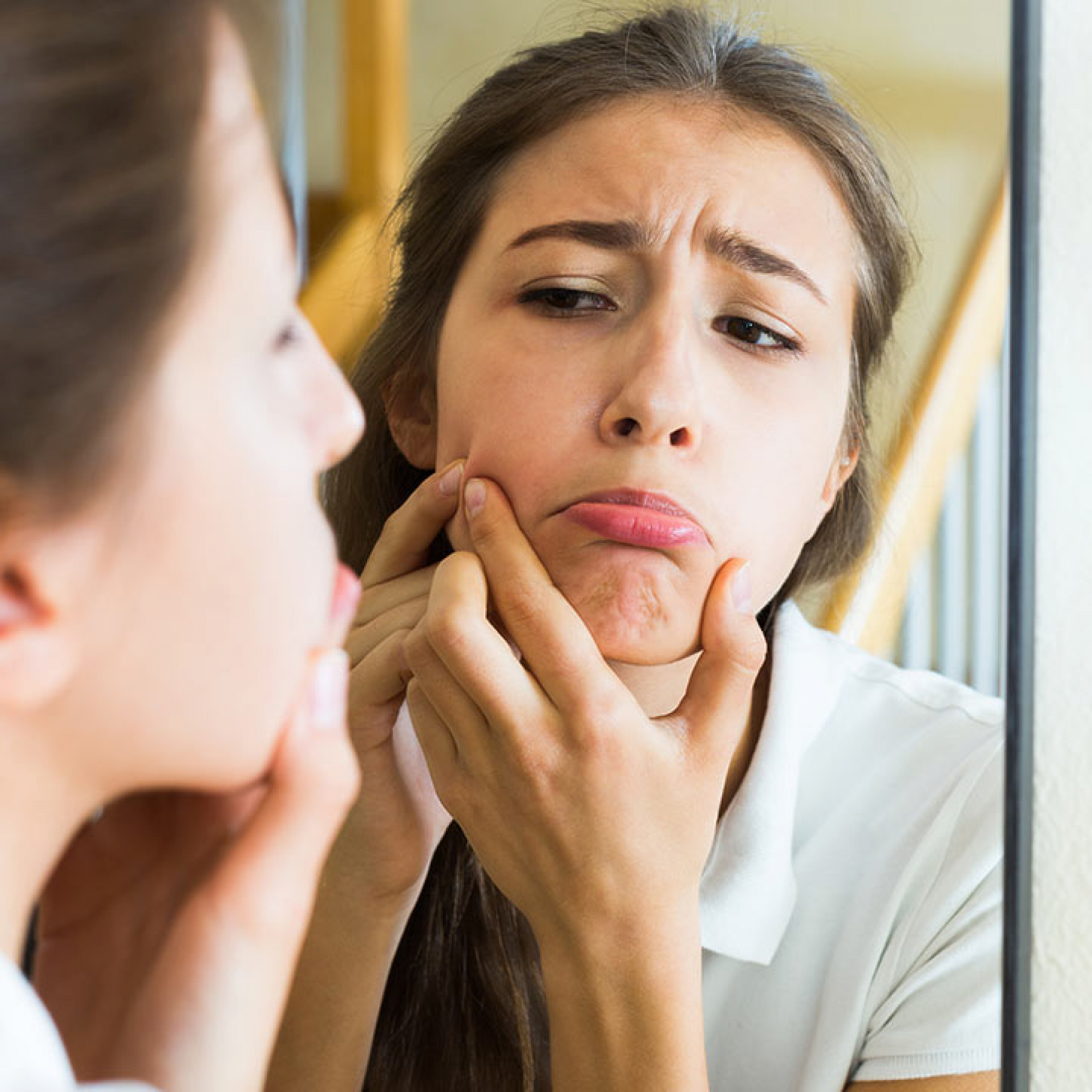 How-To-Prevent-Pimples-And-Acne-Naturally-Tips-And-Home-Remedies