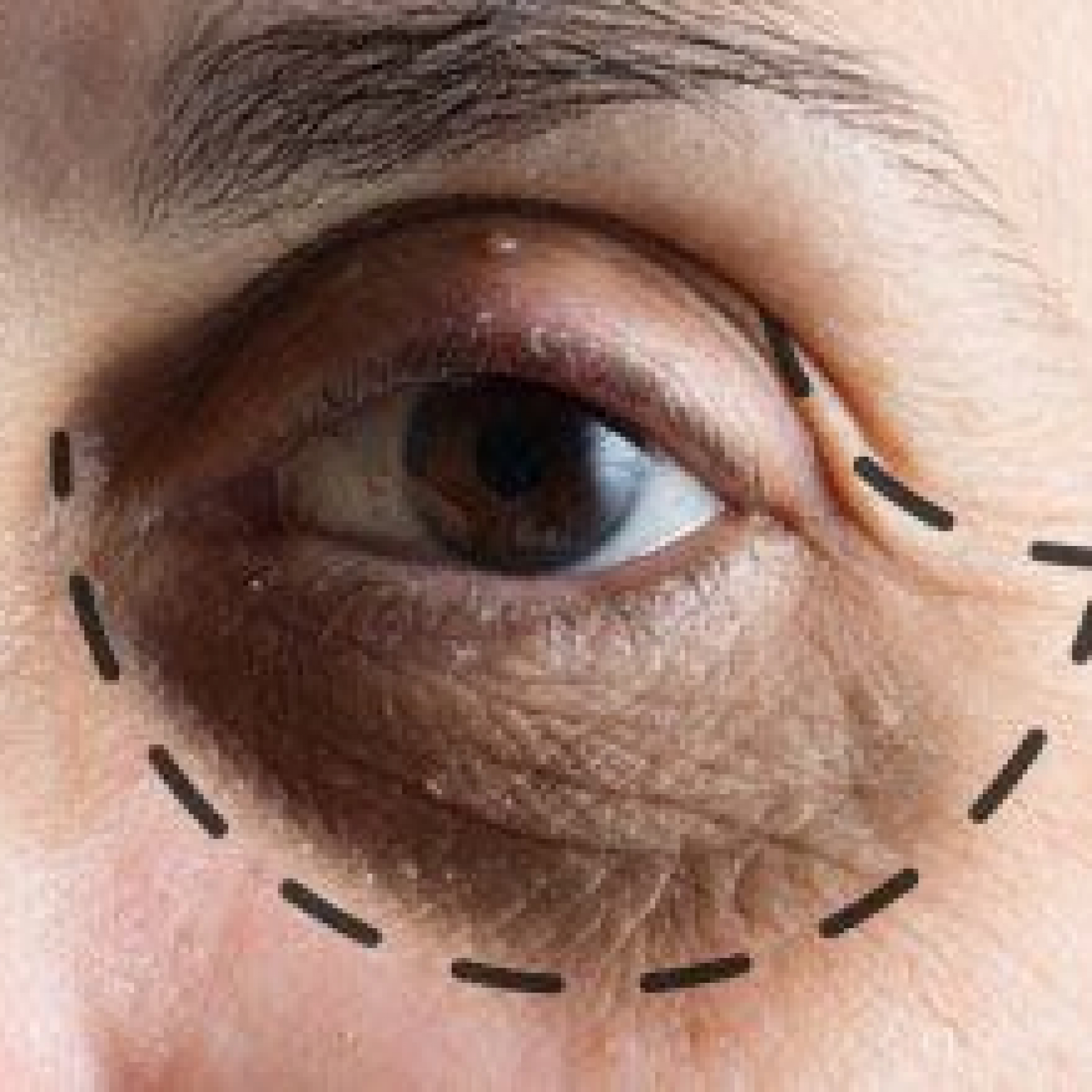 Small-Article-EyeBags-Surgery-compressor