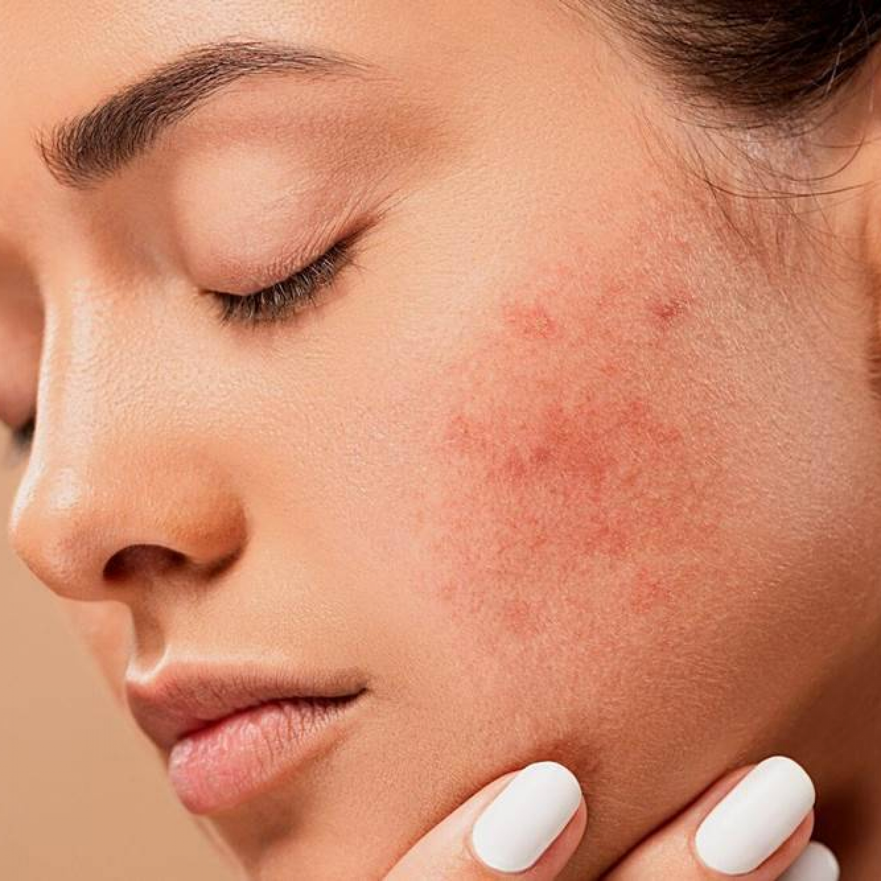 pixabay_acne-pimples_1200