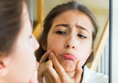 How-To-Prevent-Pimples-And-Acne-Naturally-Tips-And-Home-Remedies