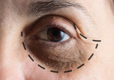Small-Article-EyeBags-Surgery-compressor