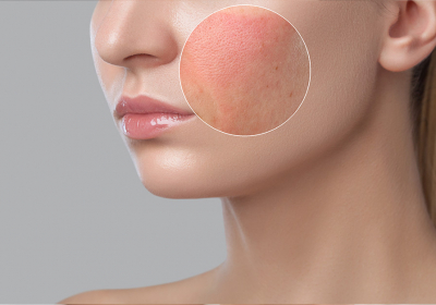 female-face-rash