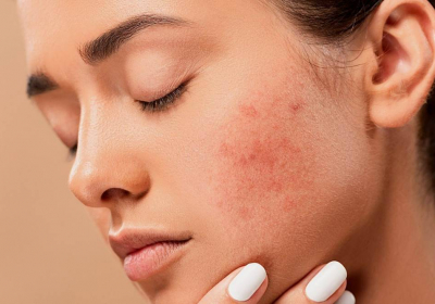 pixabay_acne-pimples_1200